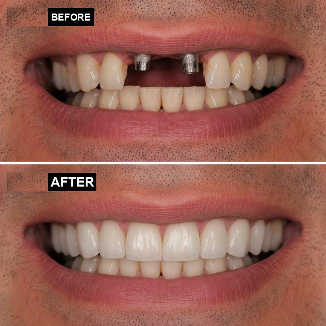 Illustrative before-and-after dental implant image, case 3