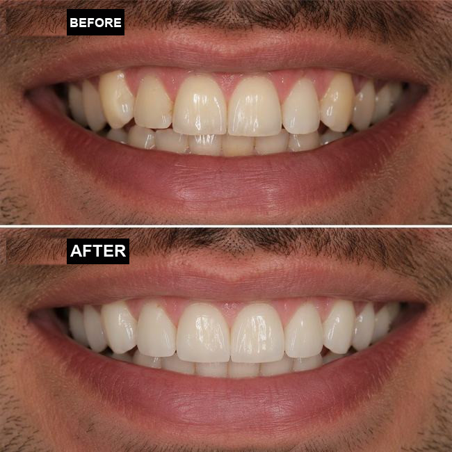 Illustrative before-and-after dental implant image, case 5